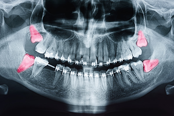 Concho Valley Family Dental | Wisdom Teeth Extractions, Teeth Whitening and Oral Exams