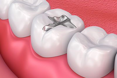 Concho Valley Family Dental | Implant Dentistry, Nitrous Oxide Sedation and Wisdom Teeth Extractions