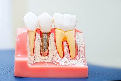 Concho Valley Family Dental | Crowns  amp  Caps, Teeth Whitening and Wisdom Teeth Extractions