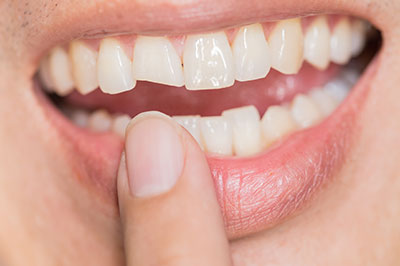 Concho Valley Family Dental | Wisdom Teeth Extractions, Dental Bridges and Preventative Program
