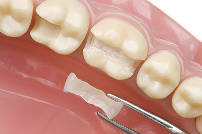 Concho Valley Family Dental | Teeth Whitening, Wisdom Teeth Extractions and Cosmetic Dentistry