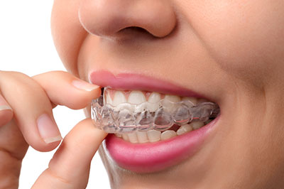 Concho Valley Family Dental | Teeth Whitening, Dentures and Night Guards