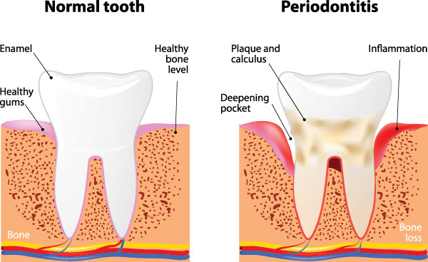 Concho Valley Family Dental | Crowns  amp  Caps, Veneers and Teeth Whitening
