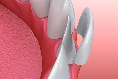 Concho Valley Family Dental | Crowns  amp  Caps, Periodontal Treatment and Dental Bridges