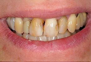 Concho Valley Family Dental | Preventative Program, Crowns  amp  Caps and Veneers